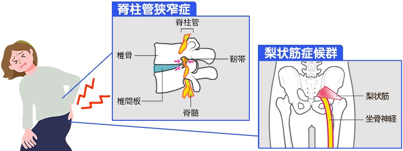 脊柱管狭窄症・梨状筋症候群のイメージ